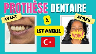 IMPLANTS DENTAIRES AVANT APRÈS à Istanbul je vous explique tout [upl. by Ytsihc]