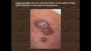 Lecture24 Panniculitis Part II Rooks chapter 99 [upl. by Eldoree]