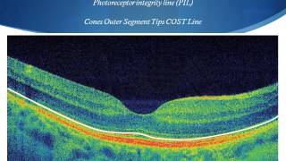 OCT Tutorial On Macular Anatomy part 1 [upl. by Adnaerb503]