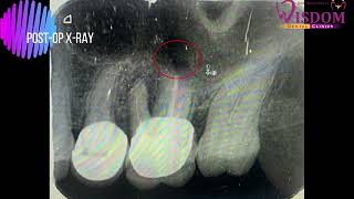 Apicoectomy of palatal root of maxillary 1st molar [upl. by Hana763]