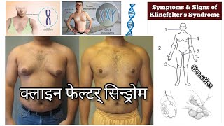 Klinefelter Syndrome  क्लाइनफेल्टर सिन्ड्रोम क्या है Klinefelter Syndrome causes symptoms in hindi [upl. by Kovar780]