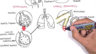 Chronic Obstructive Pulmonary Disease Overview types pathology treatment [upl. by Nelyak]