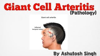 Giant Cell Arteritis Temporal Arteritis Pathology [upl. by Haididej]