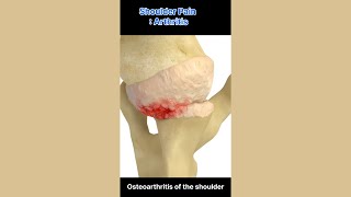 Shoulder Pain  Arthritis [upl. by Yztim]