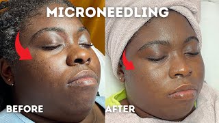 Microneedling Acne Scars  Before and After  Glam By Lia Leigh [upl. by Rachael]