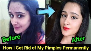 How to Remove Pimples Acne Pimple Marks completely  ThatGlamGirl [upl. by Clymer]