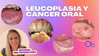 Leucoplasia y Cáncer Oral 👄 con Dra Victoria Rees [upl. by Doone970]