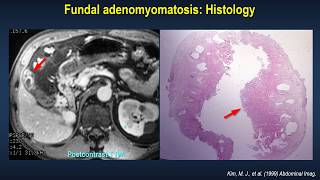 Characteristic radiological signs of gallbladder adenomyomatosis Ultrasonography CT MRI [upl. by Elliven]