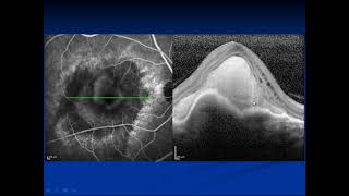 Seminario Tecnología OCT Clínica Básica Módulo II  US Ophthalmic [upl. by Marvin437]