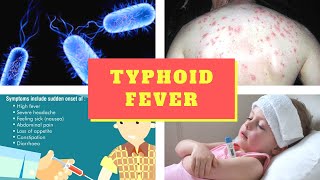 Typhoid Fever Symptoms – Causes Symptoms and Pictures of Enteric fever in Men women [upl. by Neenaej102]