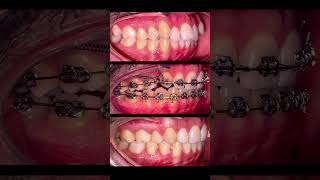 ارتودنسی با کشیدن دندان به کمک مینی اسکرو Orthodontics by extracting teeth with mini screws [upl. by Ahsenad]