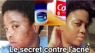 Comment traiter les boutons sur le visage  Un remède fait maison contre lacnéColgate et Vaseline [upl. by Hamil783]