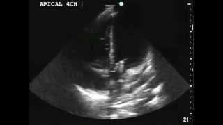 Aortic and Mitral Valve Endocarditis [upl. by Bradway]