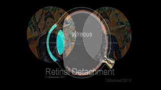 Retinal Detachment [upl. by Ahteral]