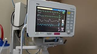 How Read PATIENT MONITOR in Hospital Resp SpO2 Pls HR Arr NBP Alarm Meaning Use Monitoring System [upl. by Nylaret]