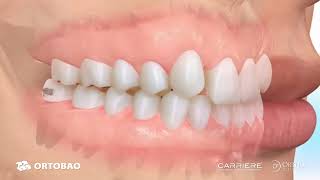 Ortobao Carriere® Clear Motion™ Class II Appliance Maxillary hypoplasia ORTOHERO [upl. by Adon]