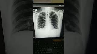 Ekspertise radiografi thorax Ini penyakitnya apa ya [upl. by Reynold]