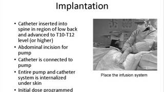 Intrathecal Baclofen Therapy for Spasticity [upl. by Jeanie920]