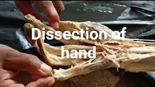 Dissection of hand Muscle of hand Anatomy of hand [upl. by Nolaj]