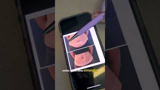 Abdominoplastia desafiadora antes e depois [upl. by Gilbertson]