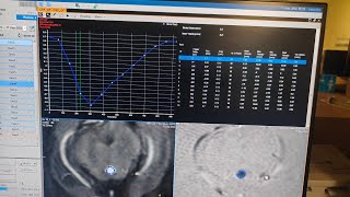 CSF Flow study in Philips3T Detalied explanation in Hindi Pat1avnishradiology [upl. by Wanonah]