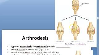 Orthopedics 102 Arthrodesis fusion of joint Triple arthrodesis for Polio CTEV GCT Osteoclastoma [upl. by Ainafetse]