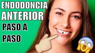 ENDODONCIA EN EL DIENTE DELANTERO ME ROMPÍ UN DIENTE COMO ES UNA ENDODONCIA COMO MTAR EL NERVIO [upl. by Eilyk]