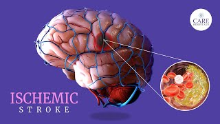 Ischemic Stroke Causes Symptoms Treatment amp Prevention  CARE Hospitals [upl. by Stephi]