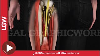 Hamstring Repair Surgery 3D animation [upl. by Jorge]