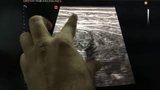 Paralytic ileus  intestinal obstruction [upl. by Holbrooke571]