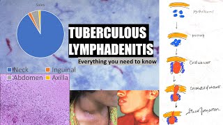 Tuberculous lymphadenitis  stages of cervical lymphadenitis  cold abscess  collar stud abscess [upl. by Ennasus212]