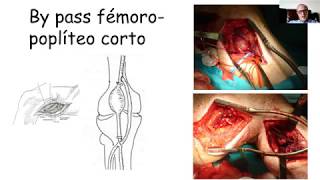 Webinar 6 Tratamiento del aneurisma poplíteo y Enfermedad Femoropoplítea [upl. by Anehta]