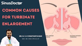 Causes for turbinate enlargement [upl. by Eric955]