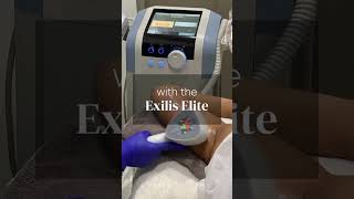 Sagging Arms Begone with Exilis Elite [upl. by Barbour414]