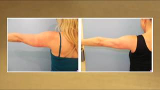 Laser Lipo for Slimmer Arms  Testimonial [upl. by Abbot658]