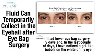 Fluid can Temporarily Collect on the Eyeball from Eye Bag Removal Surgery [upl. by Nalorac]