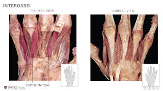 Anatomy of the Upper Limb Interossei and Lumbricals [upl. by Notsek]