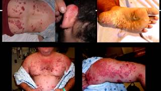 Stelara Side Effects  Stelara causes drug induced psoriasis  Biologic problems [upl. by Inanak]