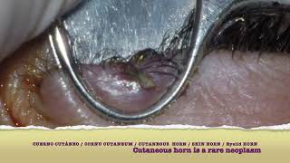 CUERNO CUTANEO  CORNU CUTANEUM  CUTANEOUS HORN  SKIN HORN  Eyelid HORN 2 [upl. by Kcirb72]