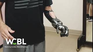 Myoelectric Upper Extremity Prosthetic Device [upl. by Arua]