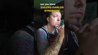 EhlersDanlos Syndromeehlersdanlossyndrome [upl. by Alsi751]