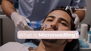 RF Aesthetics Secret  What Is Microneedling [upl. by Eylk667]