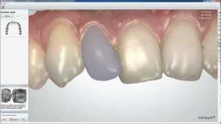 Dental System 2013  TRIOS Color Digital Temporary  3Shape [upl. by Afton311]