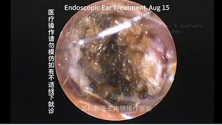 External auditory canal cholesteatoma misdiagnosed as cerumen embolism [upl. by Janeva]