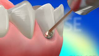 Restorative Class V  Waterlase Laser Dentistry [upl. by Nyliac]