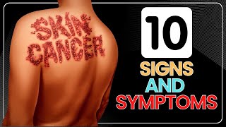 10 Skin Cancer Signs and Symptoms [upl. by Aseela979]