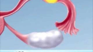 Ectopic Pregnancy Overview [upl. by Lamok]