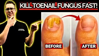 10 BEST Natural Toenail Fungus Home Remedies [upl. by Irollam]