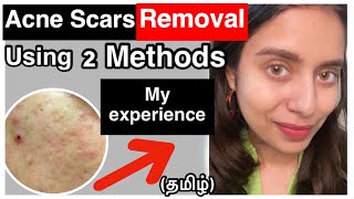 Acne Scars Removal in Tamil Using 2 Methods  pimple skincare  How to Hyperpigmentation Treatment [upl. by Pall]