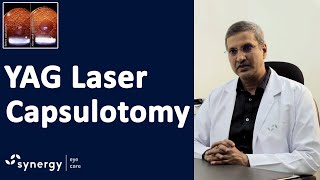 YAG Laser Capsulotomy after Cataract Surgery [upl. by Rhett168]